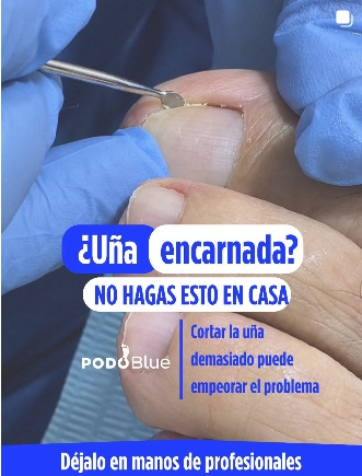 Tratamiento especializado de uñas en PodoBlue